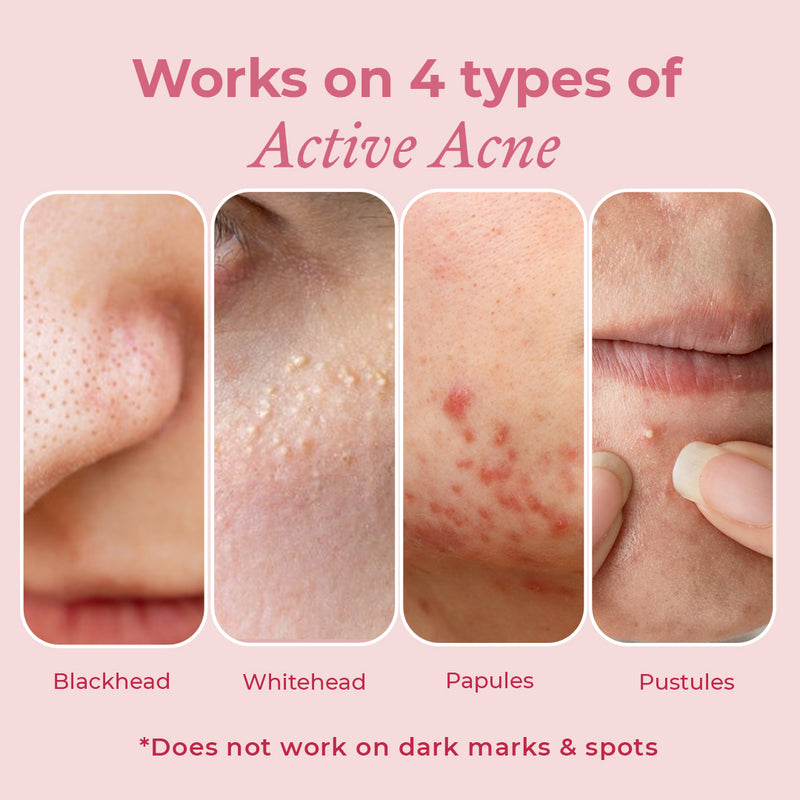 Topical treatments for acne