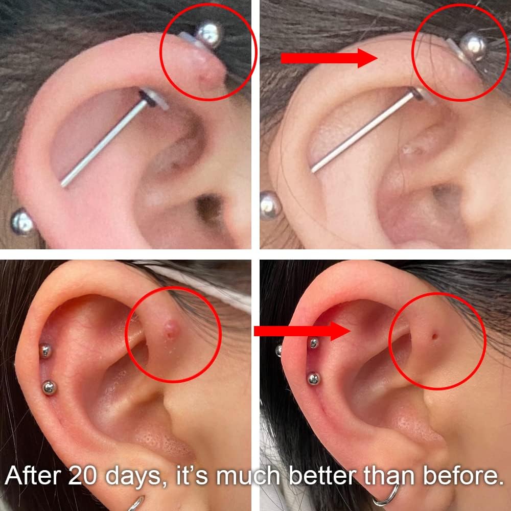 Effective Remedies for Piercing Bumps