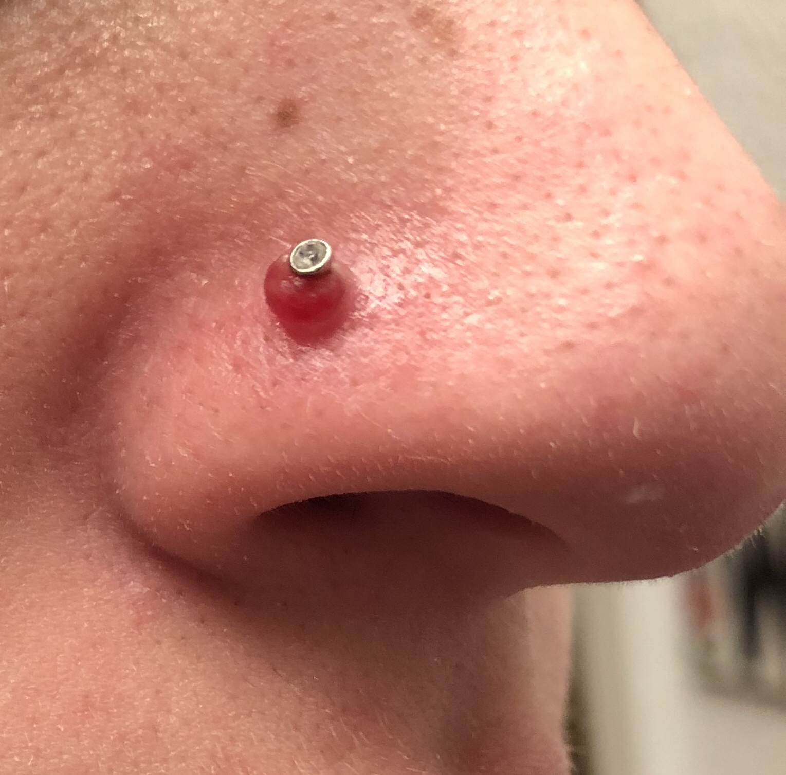 Home Treatments for Piercing Bumps