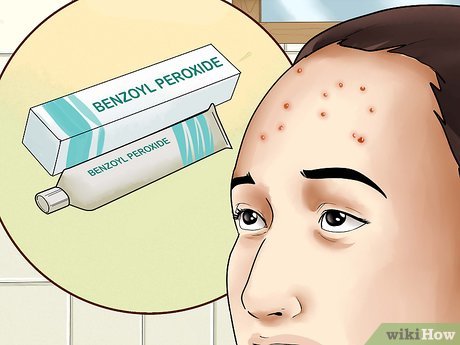 Forehead Acne Remedies Overview