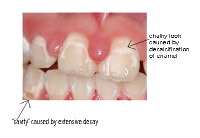 Diet for Healthy Teeth