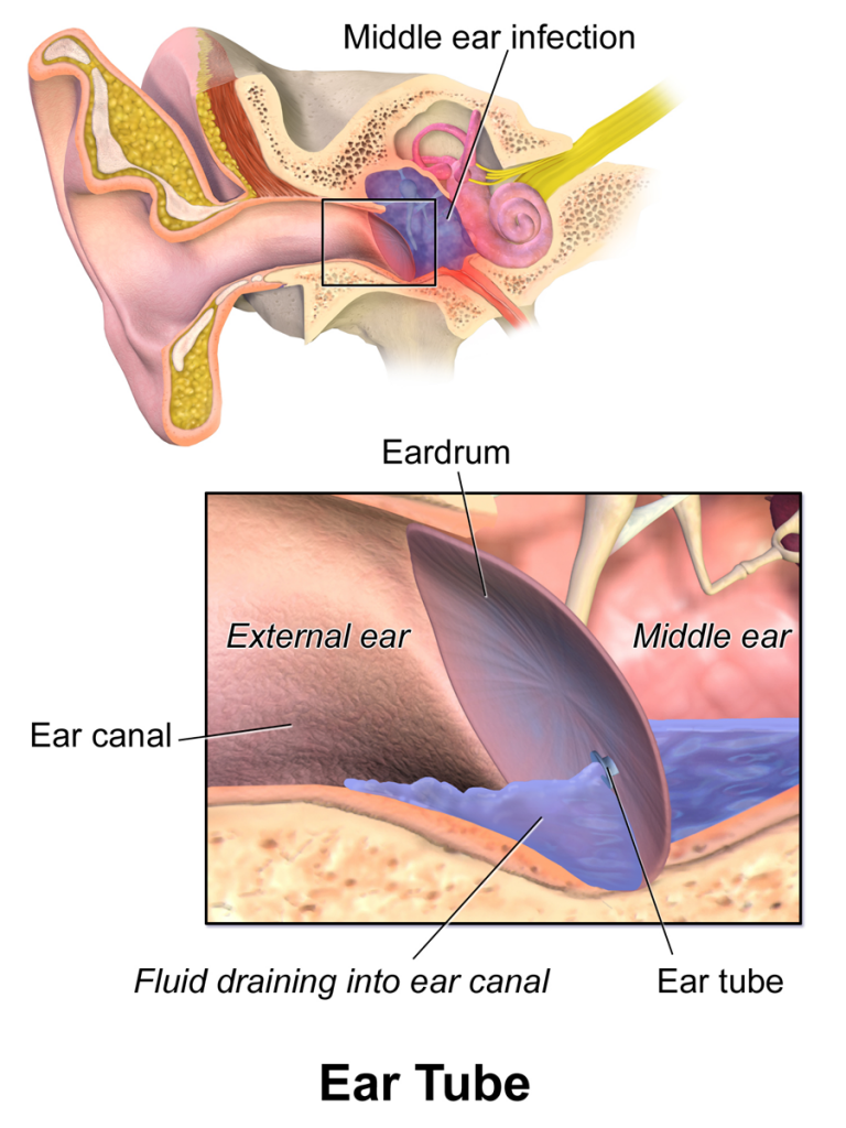 How to drain ear fluid